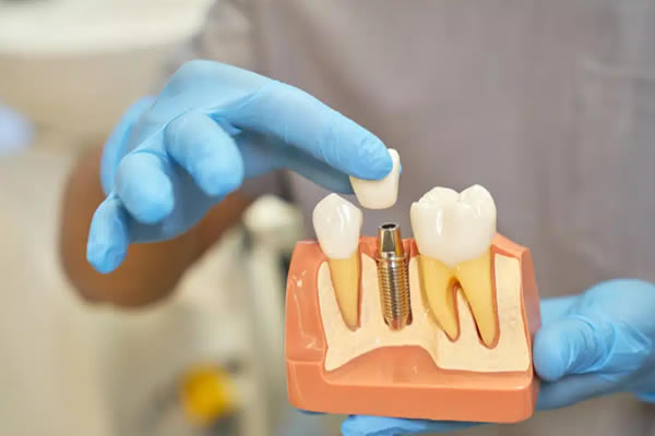 Implantes Dentários